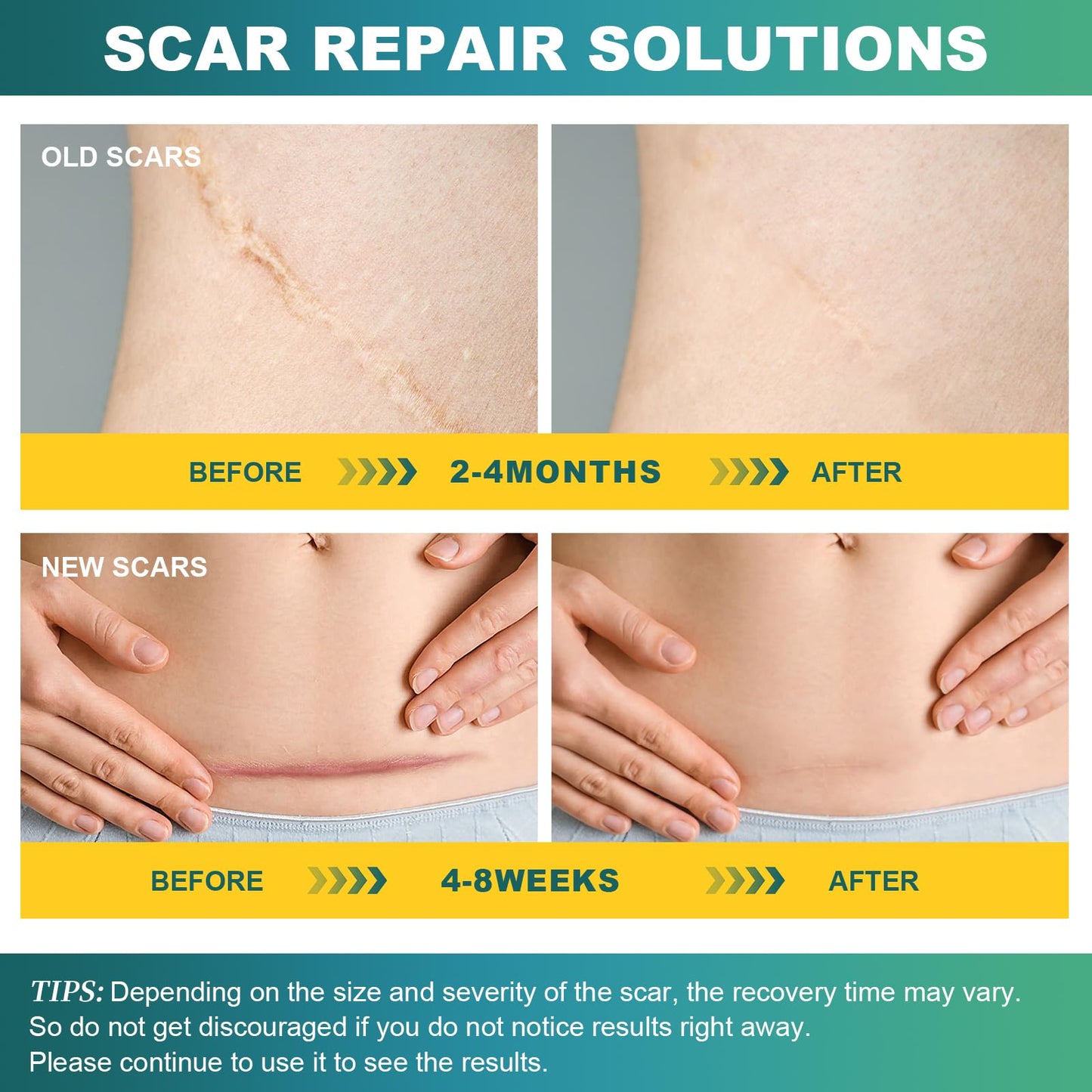 Silicone Scar Tape, Silicone Scar Sheets(1.6"X 59" Roll-1.5M), Silicone Scar Sheets for Face,Reusable Medical Grade Silicone Face Patches for Scars,C-Section,Keloid,Burn,Acne,Tummy Tuck,Surgical Scars