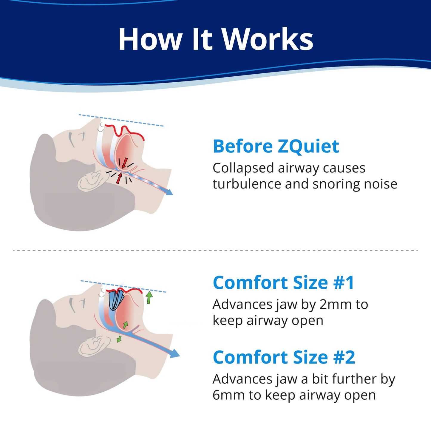 ZQuiet, Anti-Snoring Mouthpiece, Starter Pack with 2 Sizes, Living Hinge & Open Front Design for Comfort & Easy Breathing, Clear